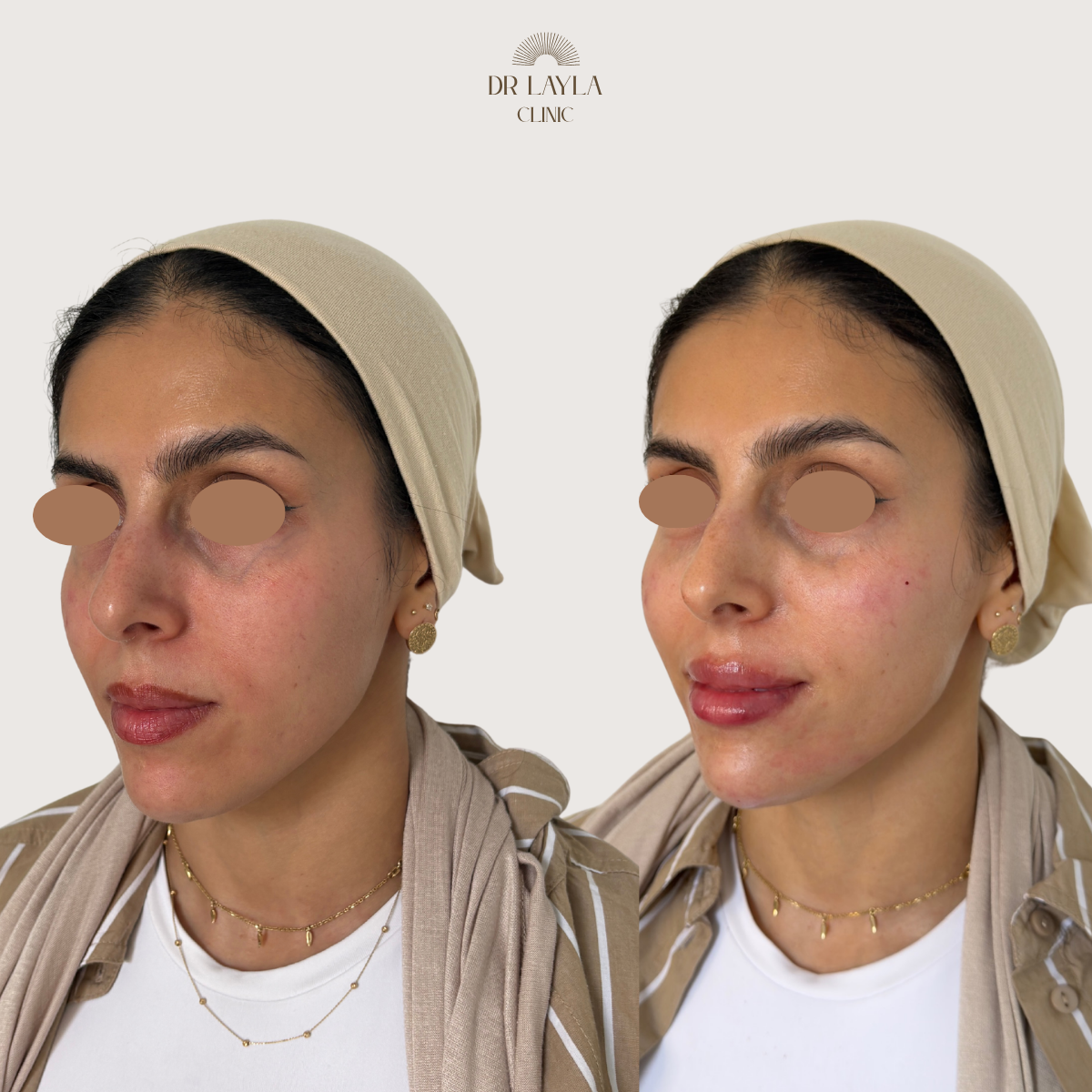 Lip filler, cheek filler, chin filler