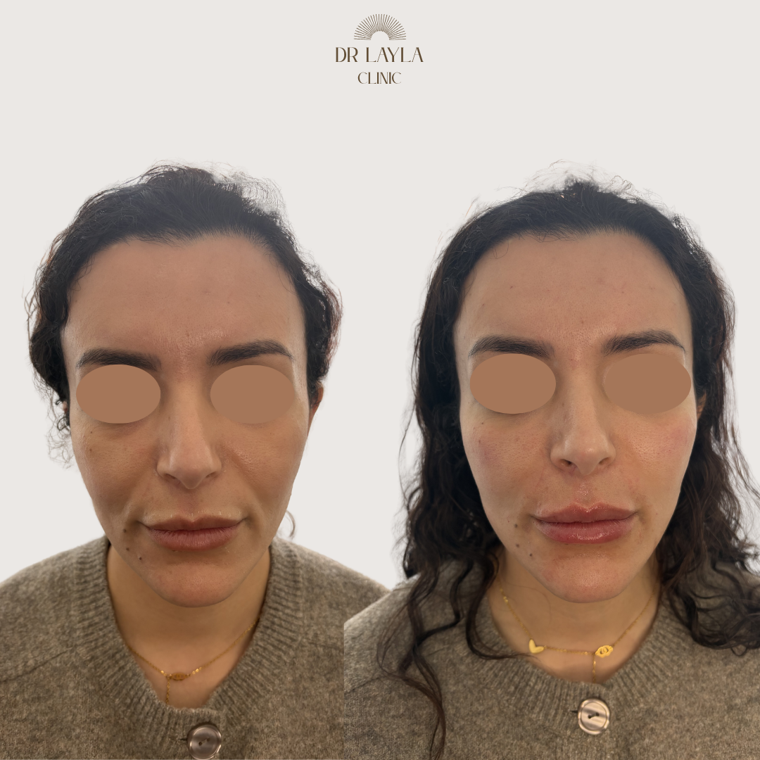 Lip filler, cheek filler, nasolabial fold filler