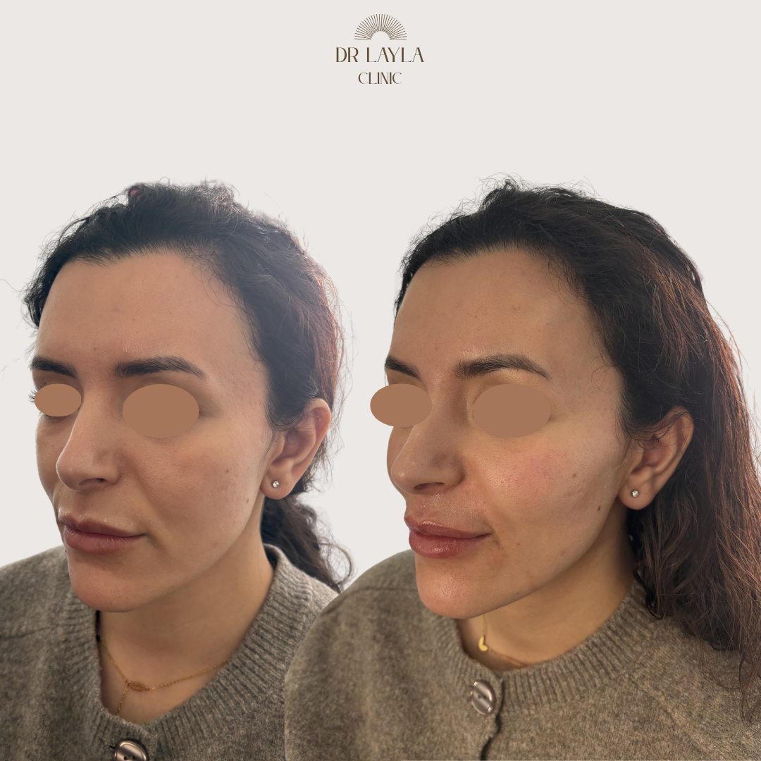 Lip filler, cheek filler, nasolabial fold filler