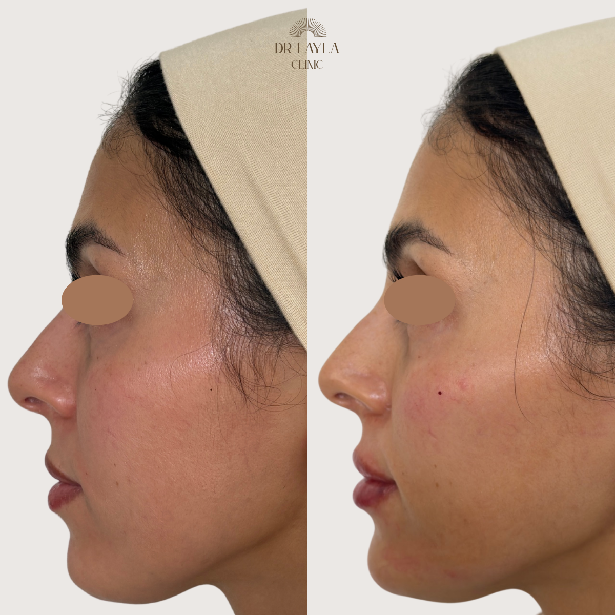 Lip filler, cheek filler, chin filler