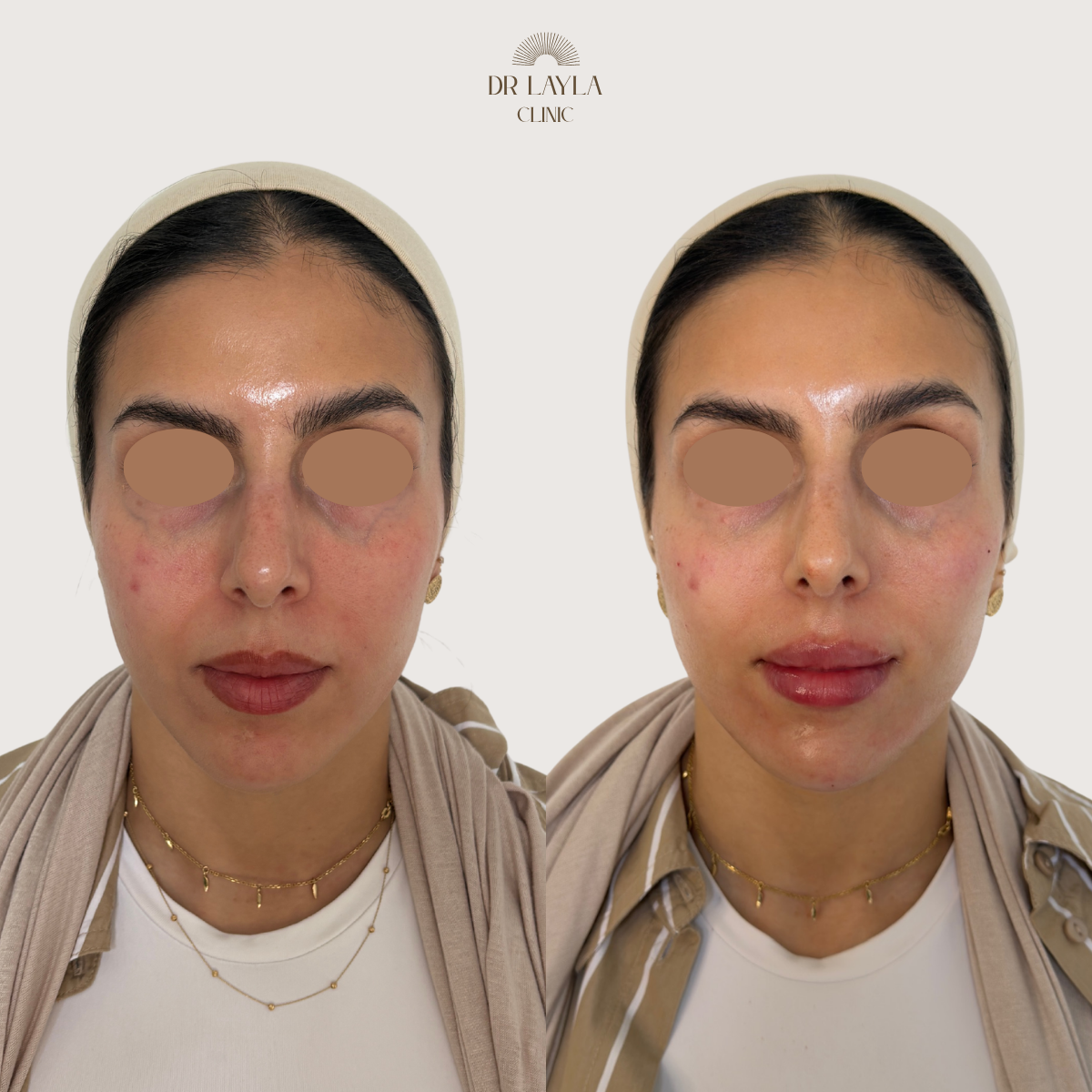 Lip filler, cheek filler, chin filler