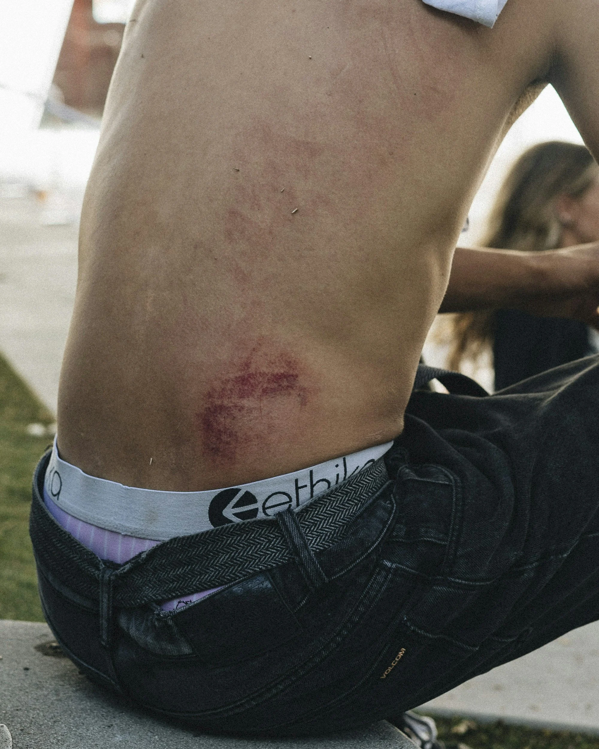 Close-up of a person's torso with visible red skin irritation, scratches, and small puncture marks, standing outdoors on a concrete sidewalk.