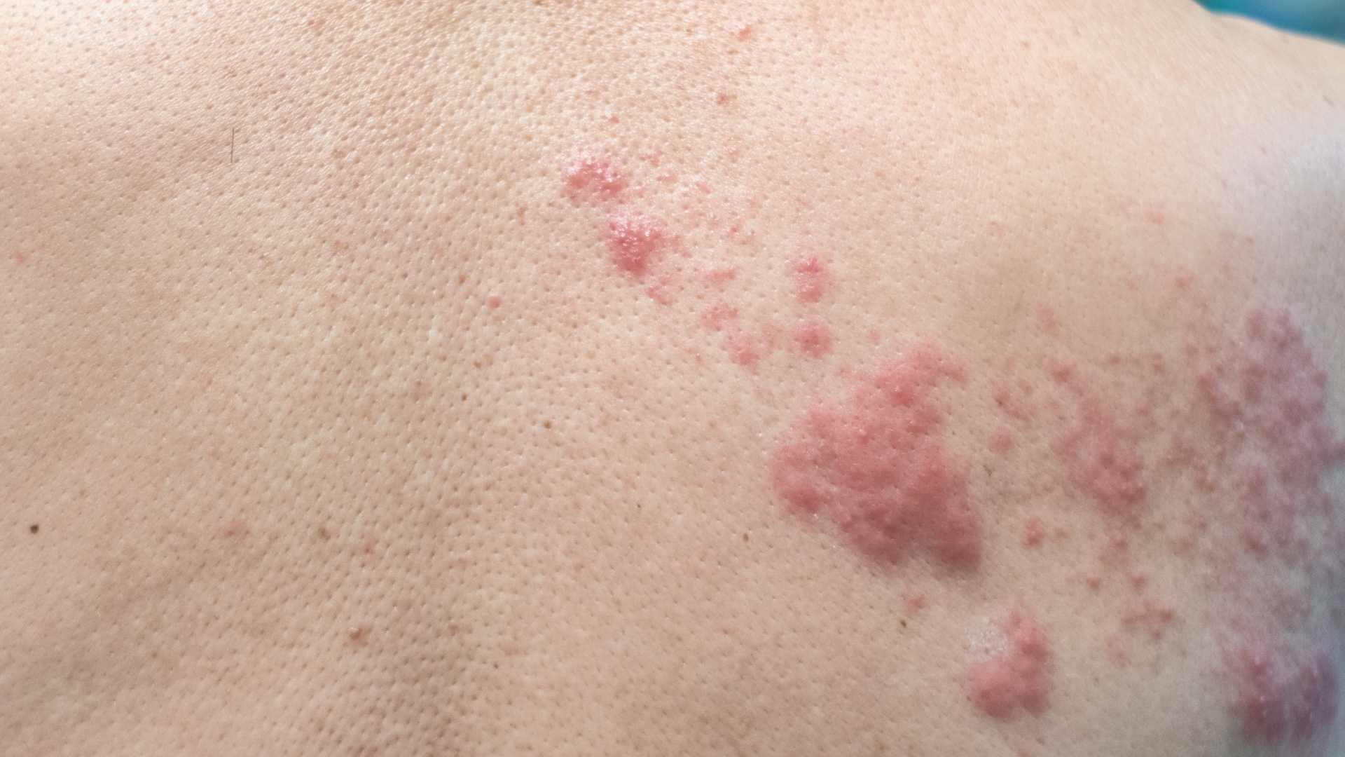 Histamine Intolerance, SIBO &amp; the Nervous System: Why You React to Everything