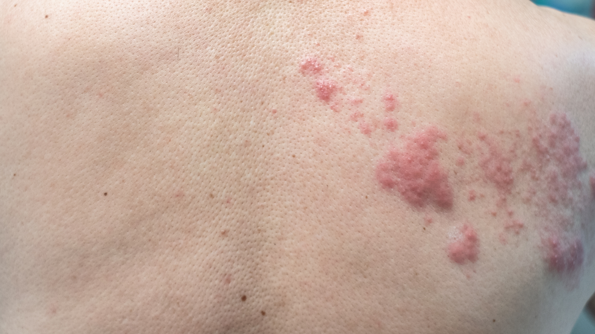 When Your Body Overreacts: Understanding Histamine Intolerance and MCAS