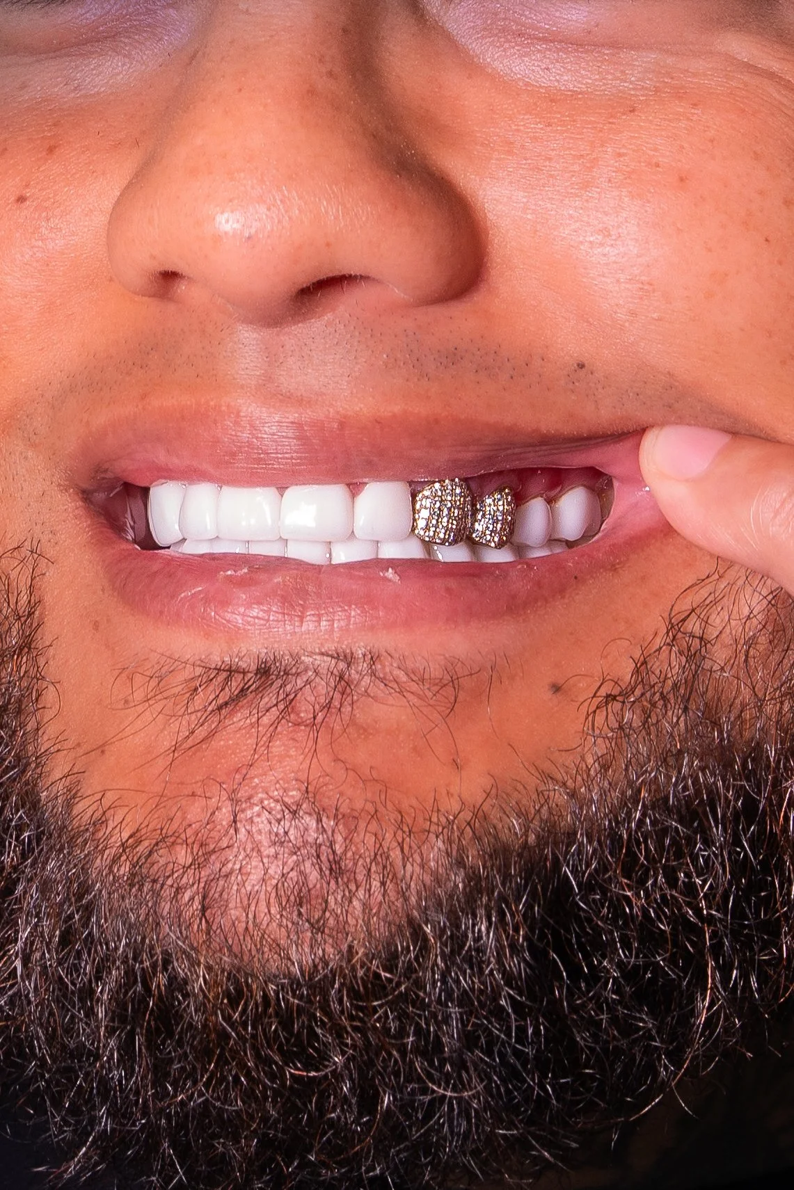 Close-up of a man's face showing his nose, lips, and beard, with a focus on his gold and diamond dental grillz in his upper teeth.