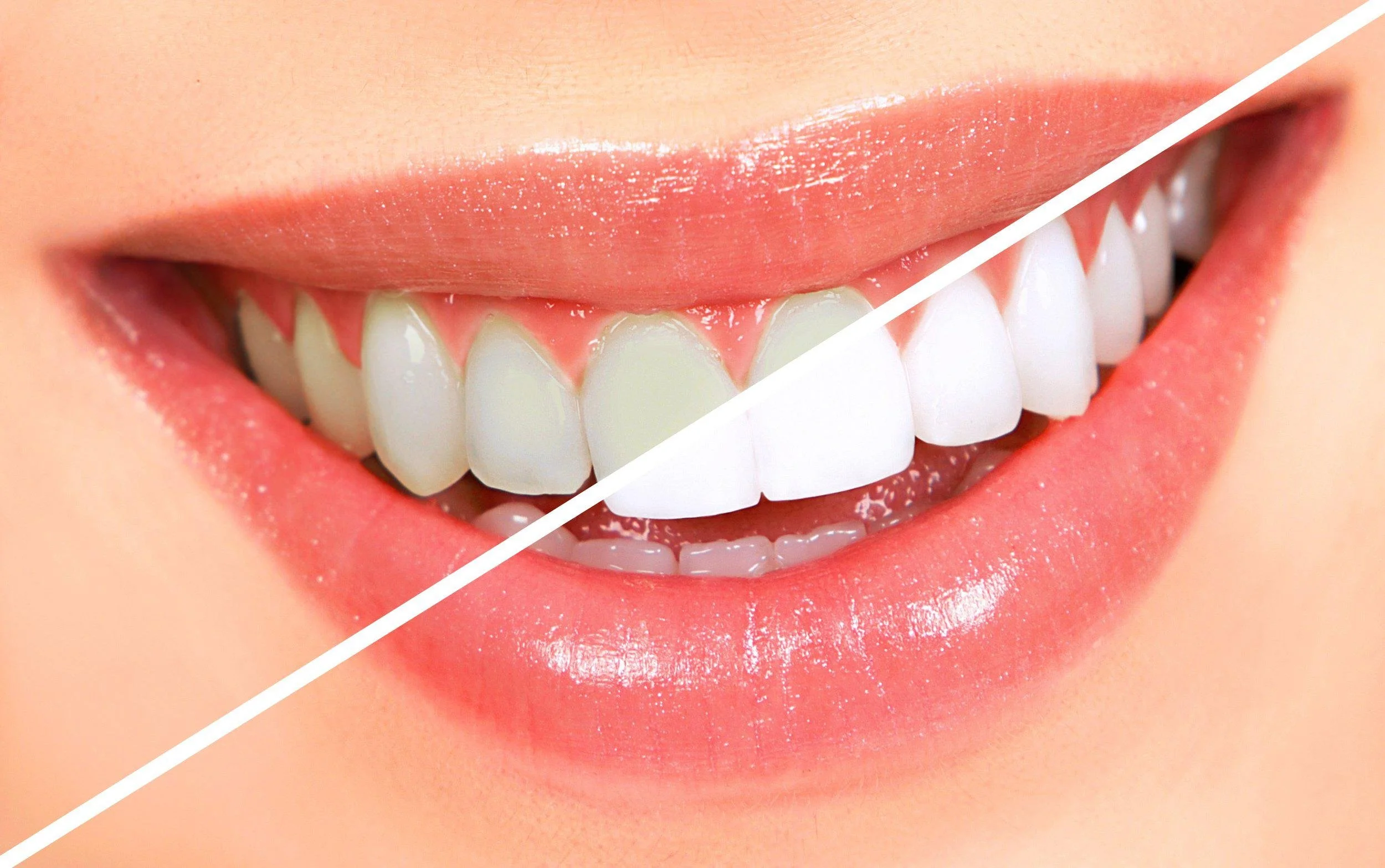 Teeth whitening safety guide — professional whitening at Stoneridge Dental Pleasanton CA