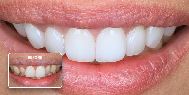 Porcelain veneers before and after, Southport Gold Coast dentist