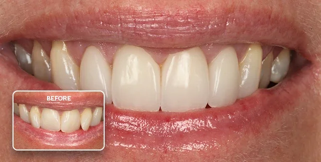 Porcelain veneers before and after, Southport Gold Coast dentist 1
