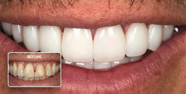Porcelain veneers before and after, Southport Gold Coast dentist 2