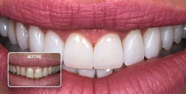 Porcelain veneers before and after, Southport Gold Coast dentist 3