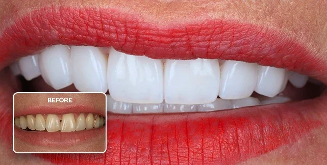 Porcelain veneers before and after, Southport Gold Coast dentist 4