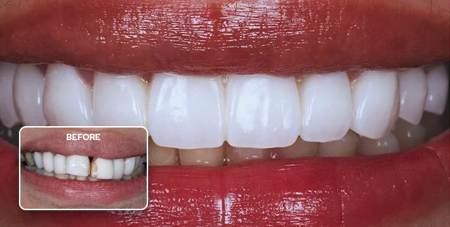 Porcelain veneers before and after, Southport Gold Coast dentist 5