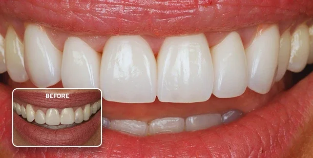 Porcelain veneers before and after, Southport Gold Coast dentist. Results for Emily Jade O'Keeffe from Hot Tomato Radio Station