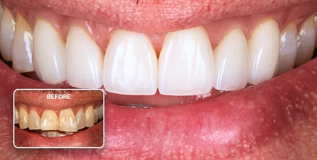 Porcelain veneers before and after, Southport Gold Coast dentist 7