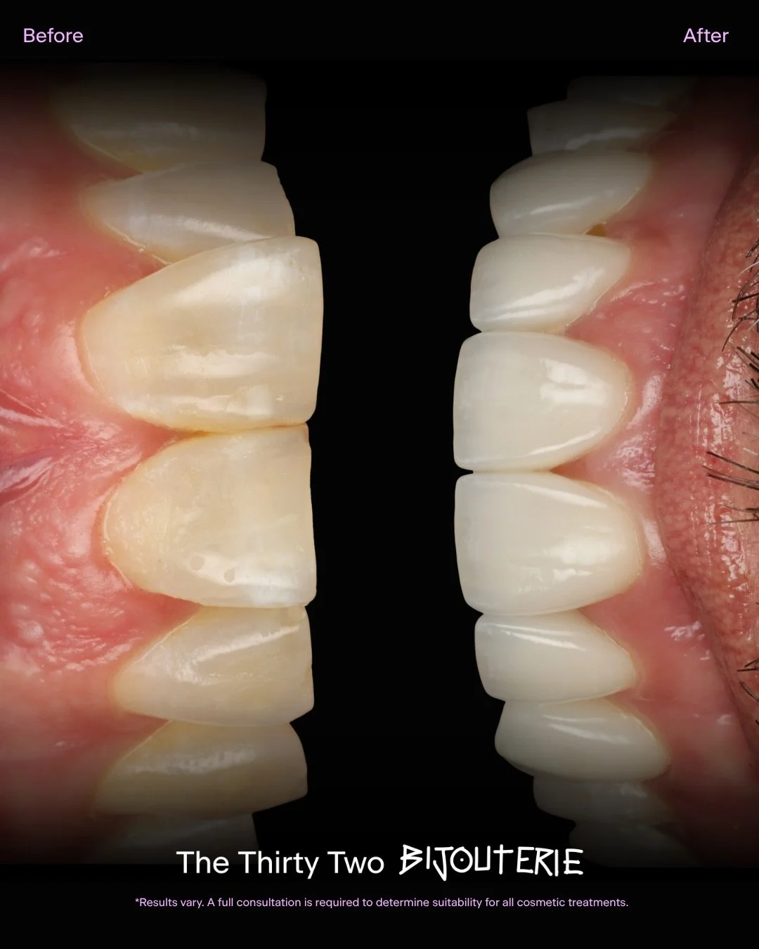 Refined smiles, thoughtfully designed. Porcelain veneers that are tailored to enhance your natural features, never overpower them.

Book your complimentary consultation via the link in bio - we&rsquo;ll handle the rest.

#thethirtytwo #dentalstudio #