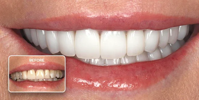 Porcelain veneers before and after, Southport Gold Coast dentist 6