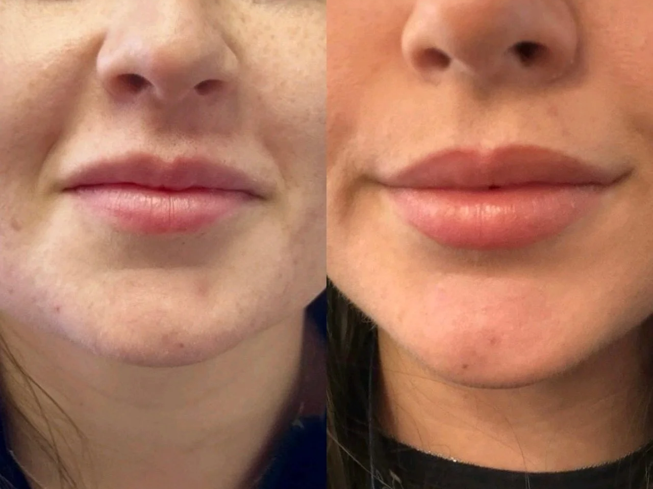 Close-up of a woman's lips, showing before and after cosmetic lip enhancement.
