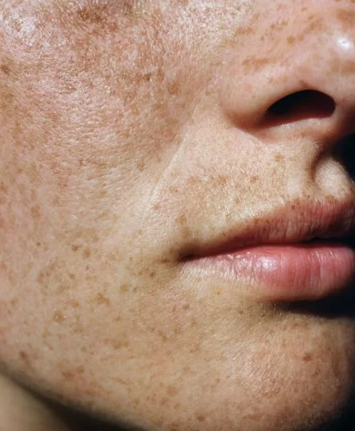 Herpes labial