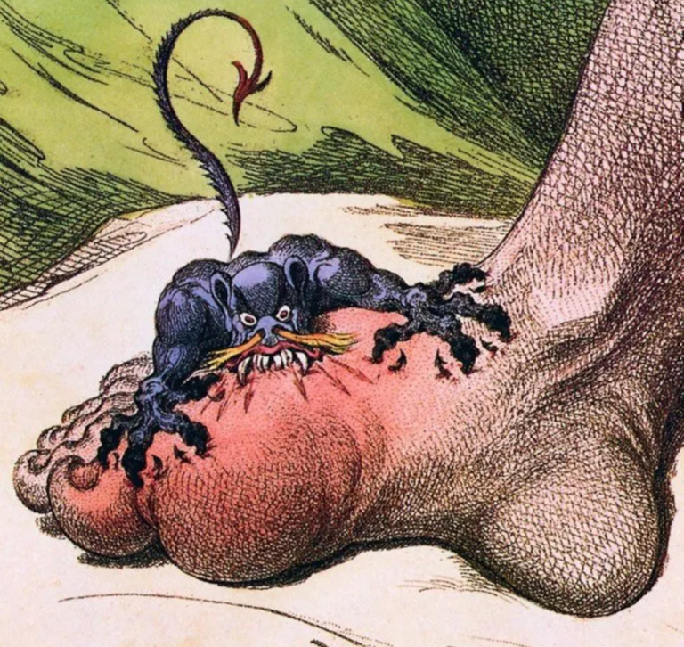 Gout, the Disease of Kings, and how to avoid it.