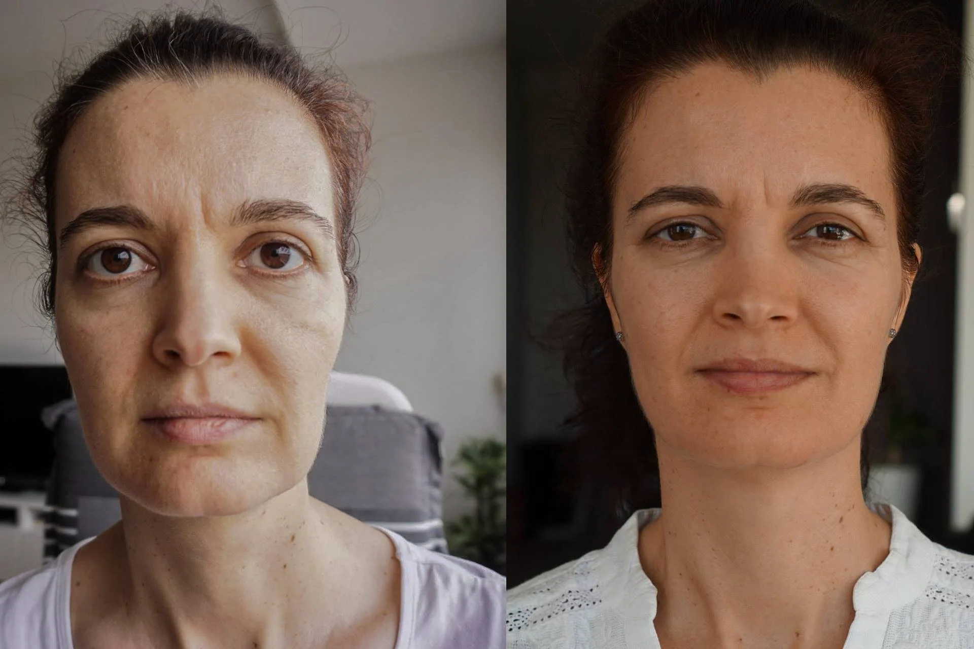 TG Graves Disease.jpg