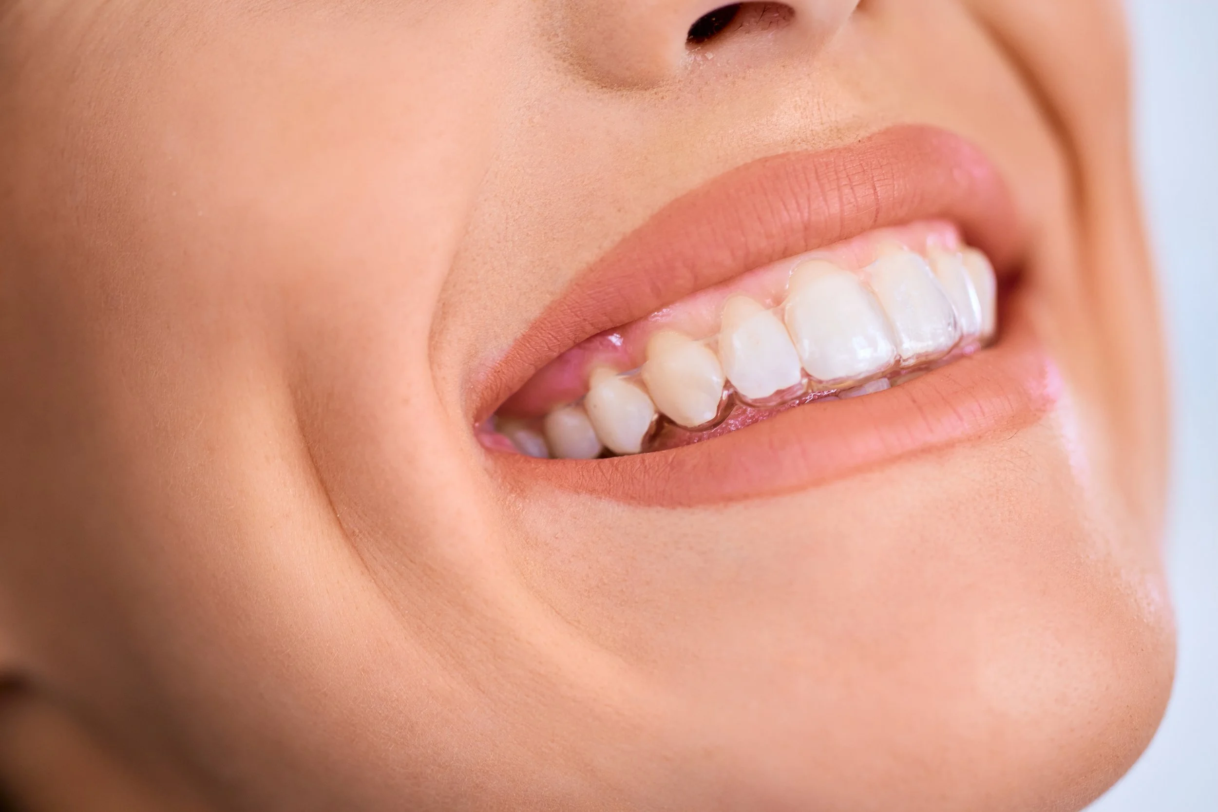 close-up-of-woman-s-teeth-with-invisible-aligners-2026-01-06-10-28-06-utc.jpg