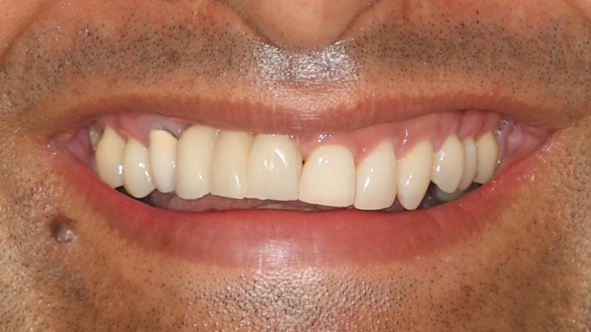 Invisalign, lower incisor extraction, whitening and composite bonding