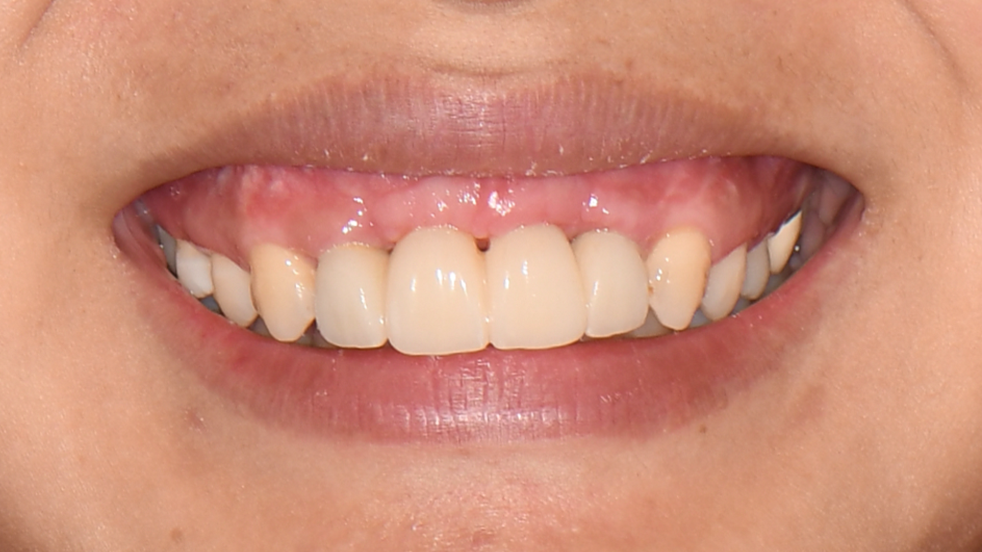 Invisalign, lower incisor extraction, whitening and composite bonding