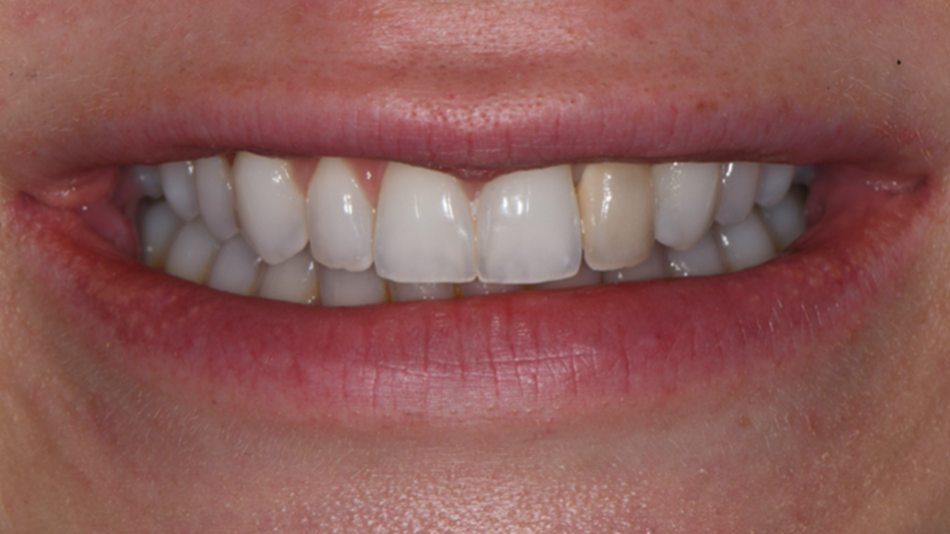 Invisalign, lower incisor extraction, whitening and composite bonding