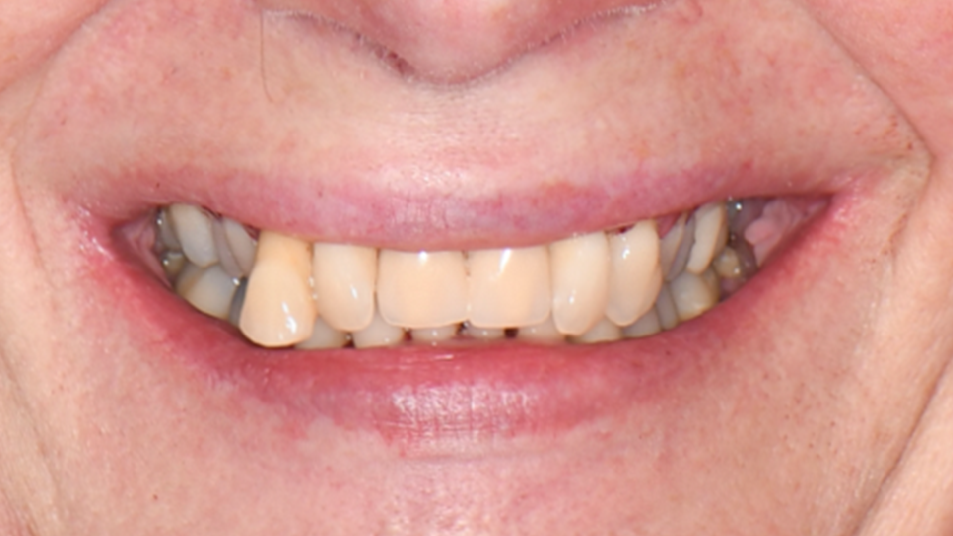 Invisalign, lower incisor extraction, whitening and composite bonding