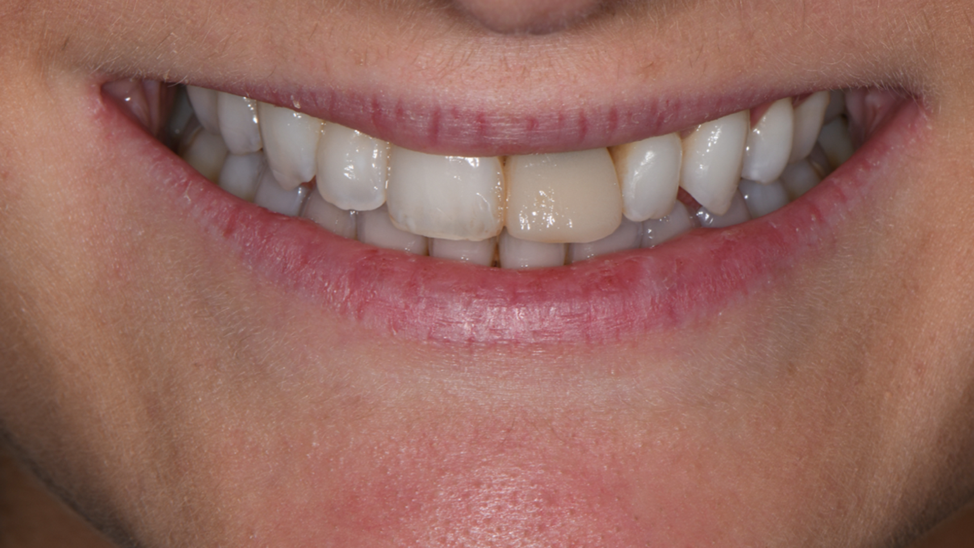 Invisalign, lower incisor extraction, whitening and composite bonding