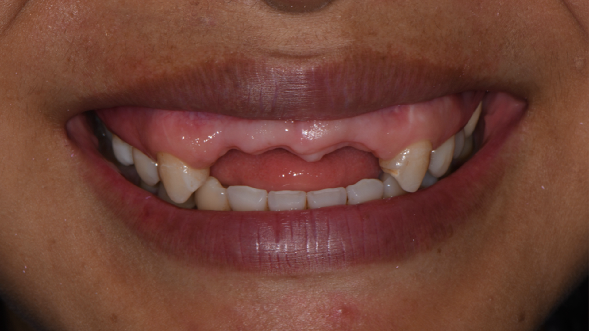 Invisalign, lower incisor extraction, whitening and composite bonding