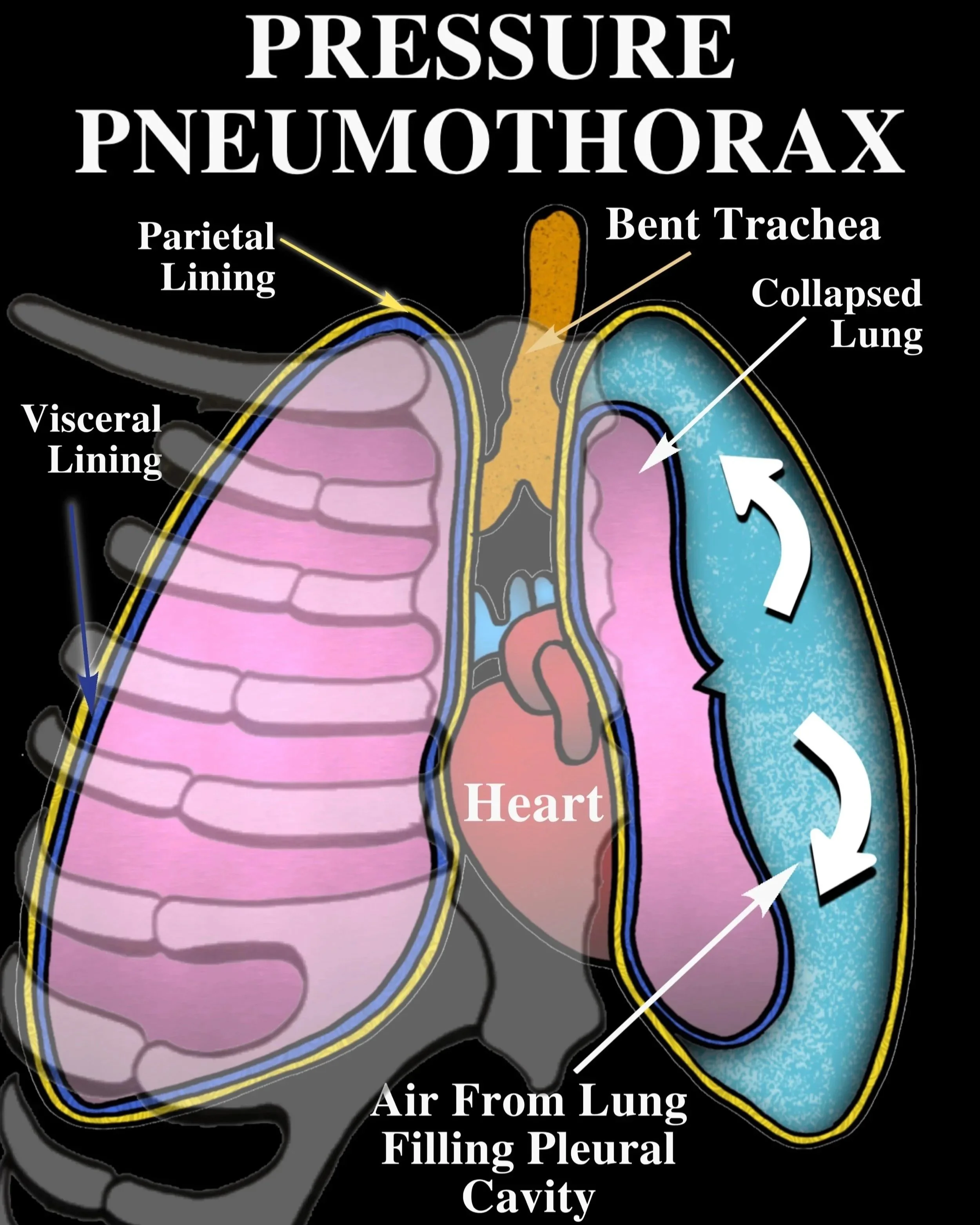 Diagram illustrating pneumothorax, showing pressure buildup in the pleural cavity causing lung collapse, with labels for parietal lining, visceral lining, bent trachea, heart, and air from lung filling pleural cavity.