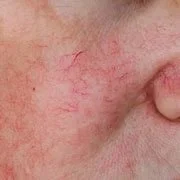 Close-up of skin showing visible spider veins and redness.