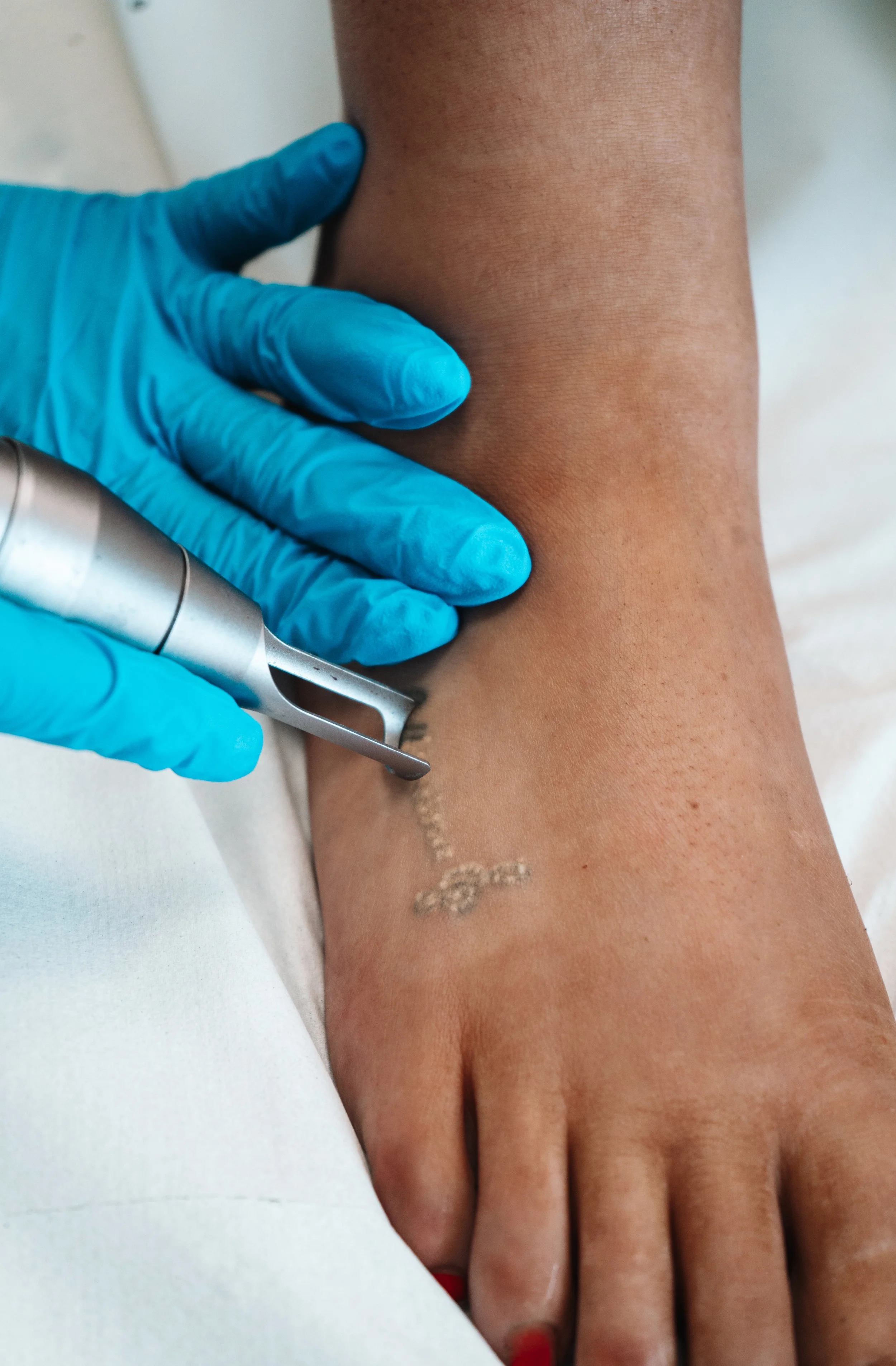 Laser tattoo removal in Ashford, Kent at The Skin Laser Studio, offering safe, effective tattoo fading and removal treatments.