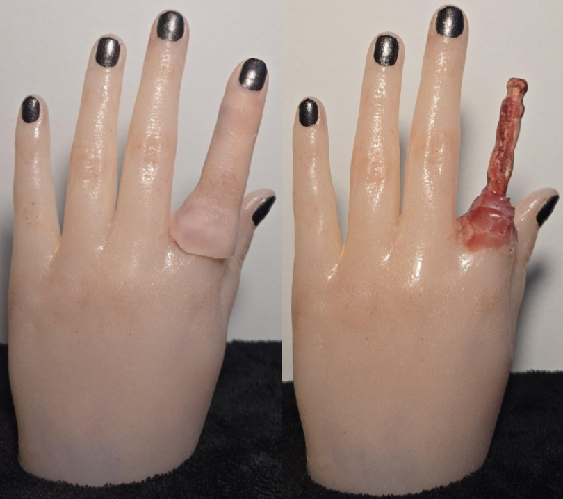 Degloved Finger