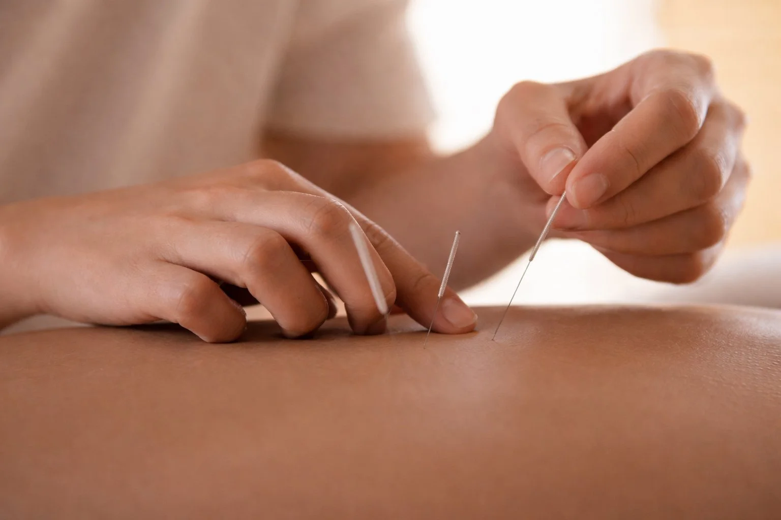 Person receiving acupuncture treatment with thin needles inserted into the skin.
