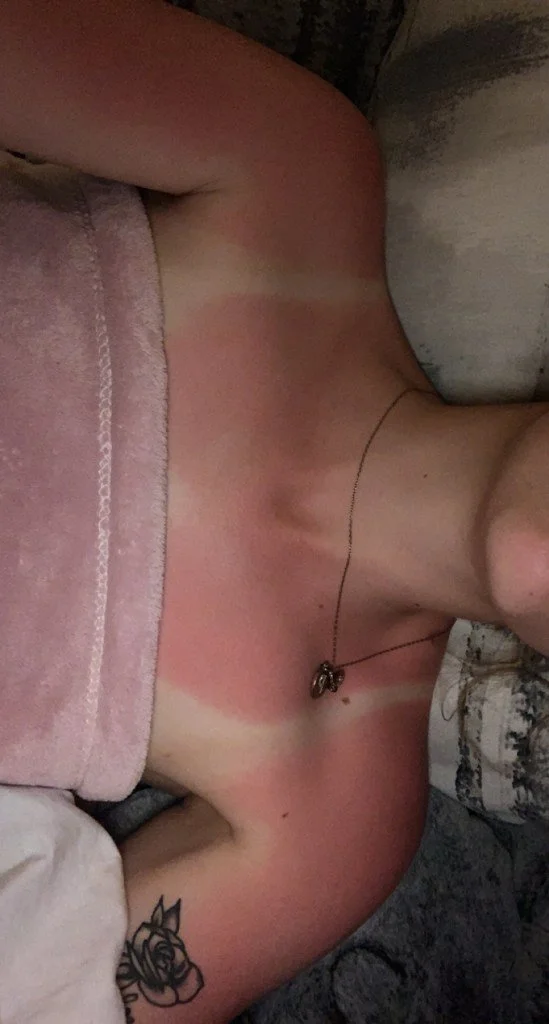 Mein guter alter Freund, der Sonnenbrand, auch wieder am Start…