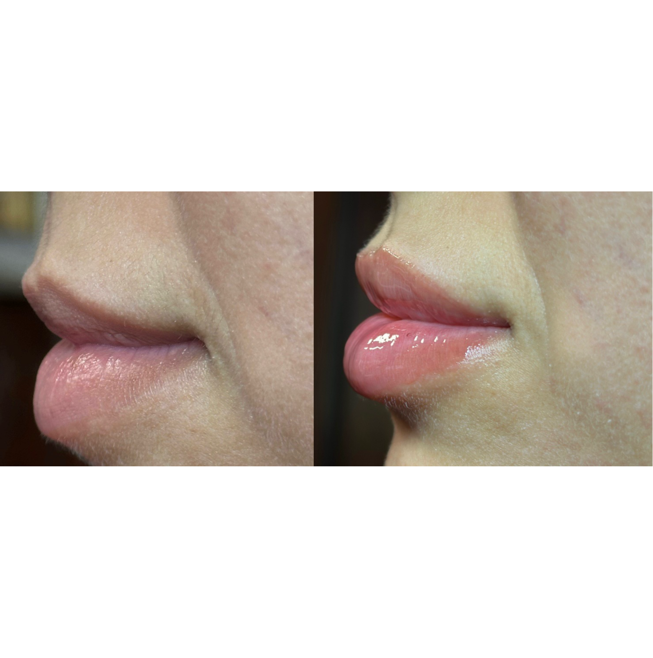 Close-up side view of a person's face showing the nose, lips, and part of the cheeks with clear skin.