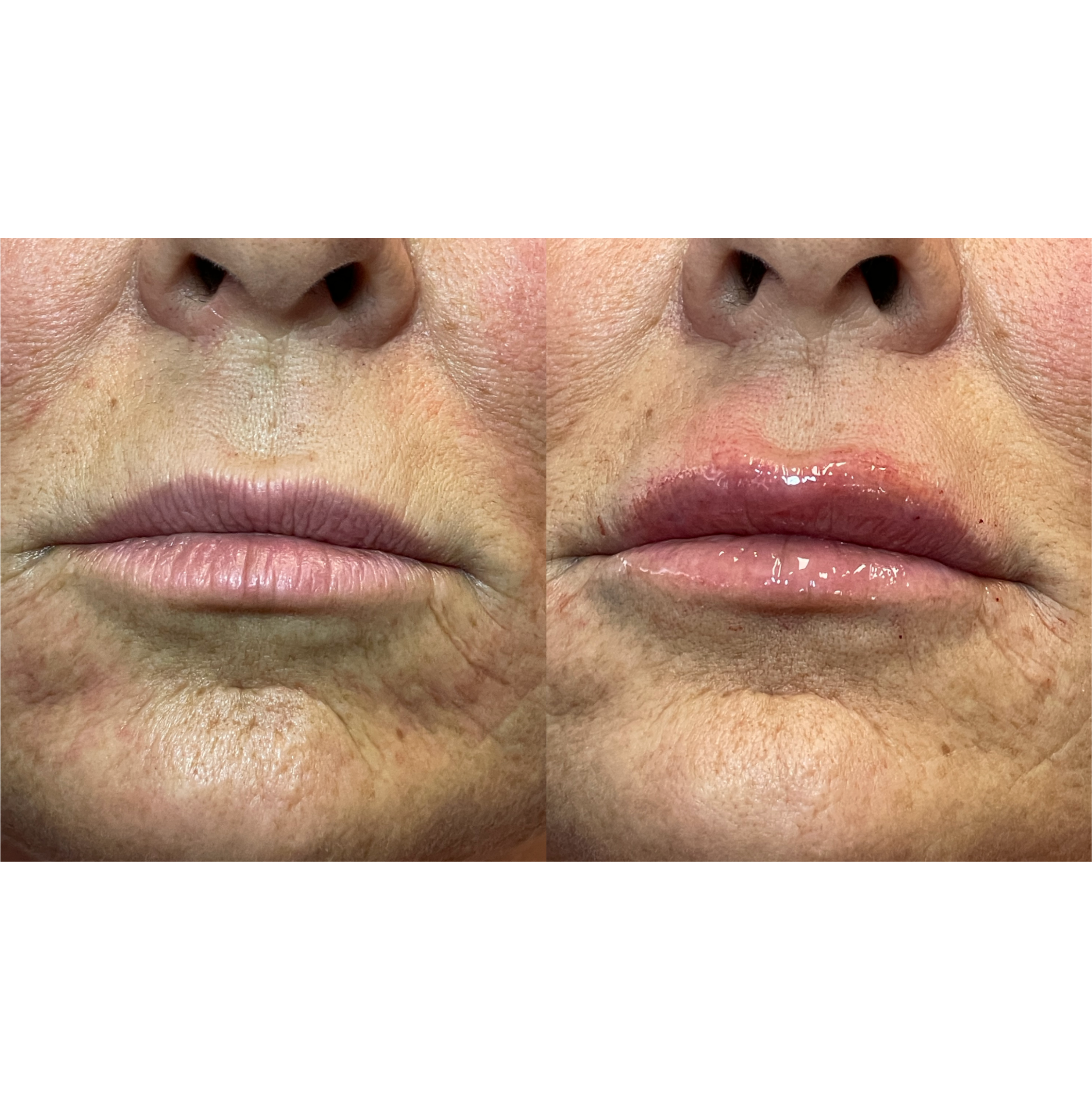 Close-up image showing the nose and lips of a person with visible skin texture and pores, with a before-and-after comparison.