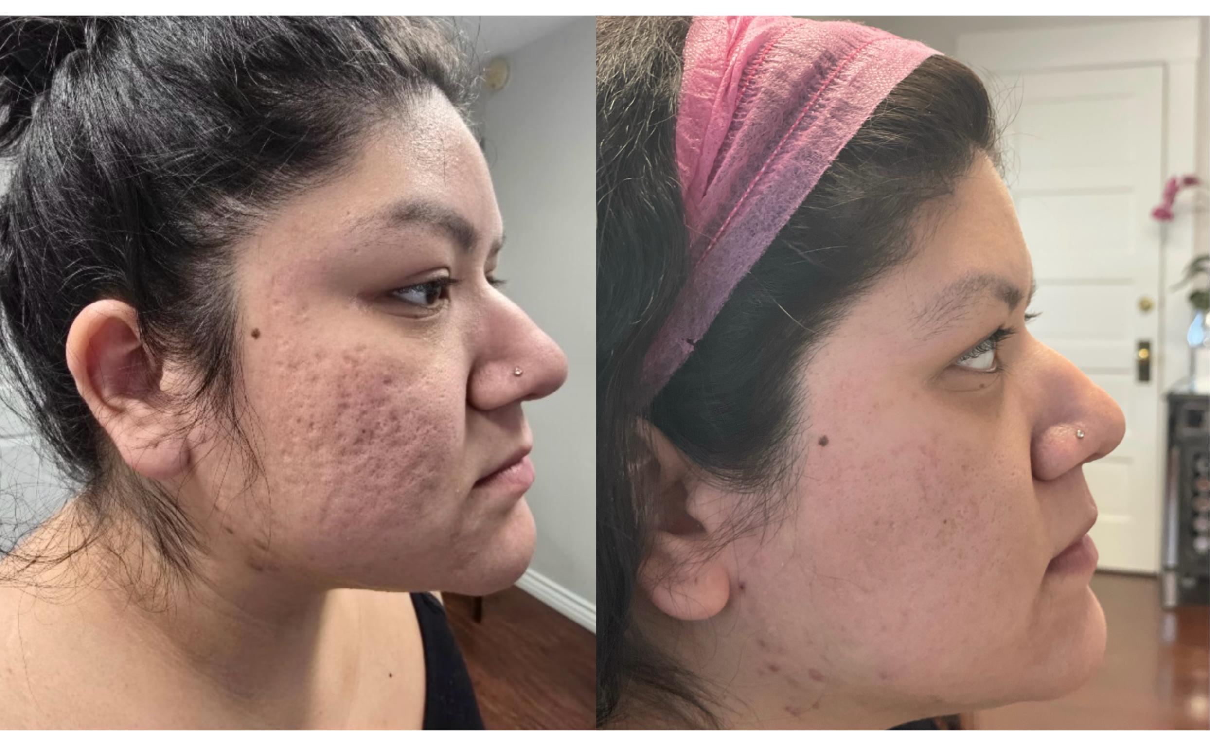 Before and after images of a woman showing improvement in skin condition, with noticeable reduction in acne and blemishes.
