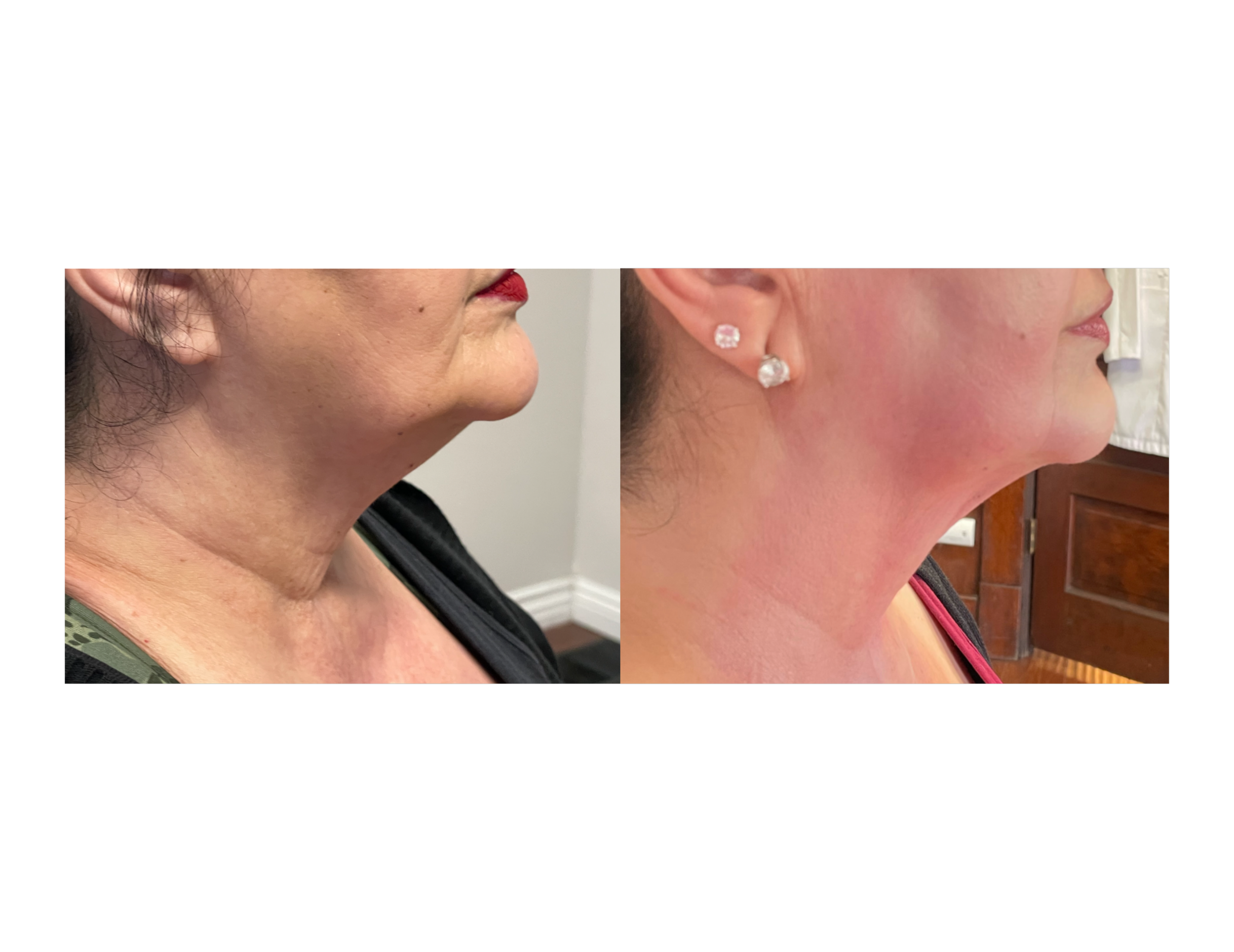 Side-by-side comparison of a woman's chin and neck area before and after cosmetic treatment, showing improvements in skin smoothness and contours.