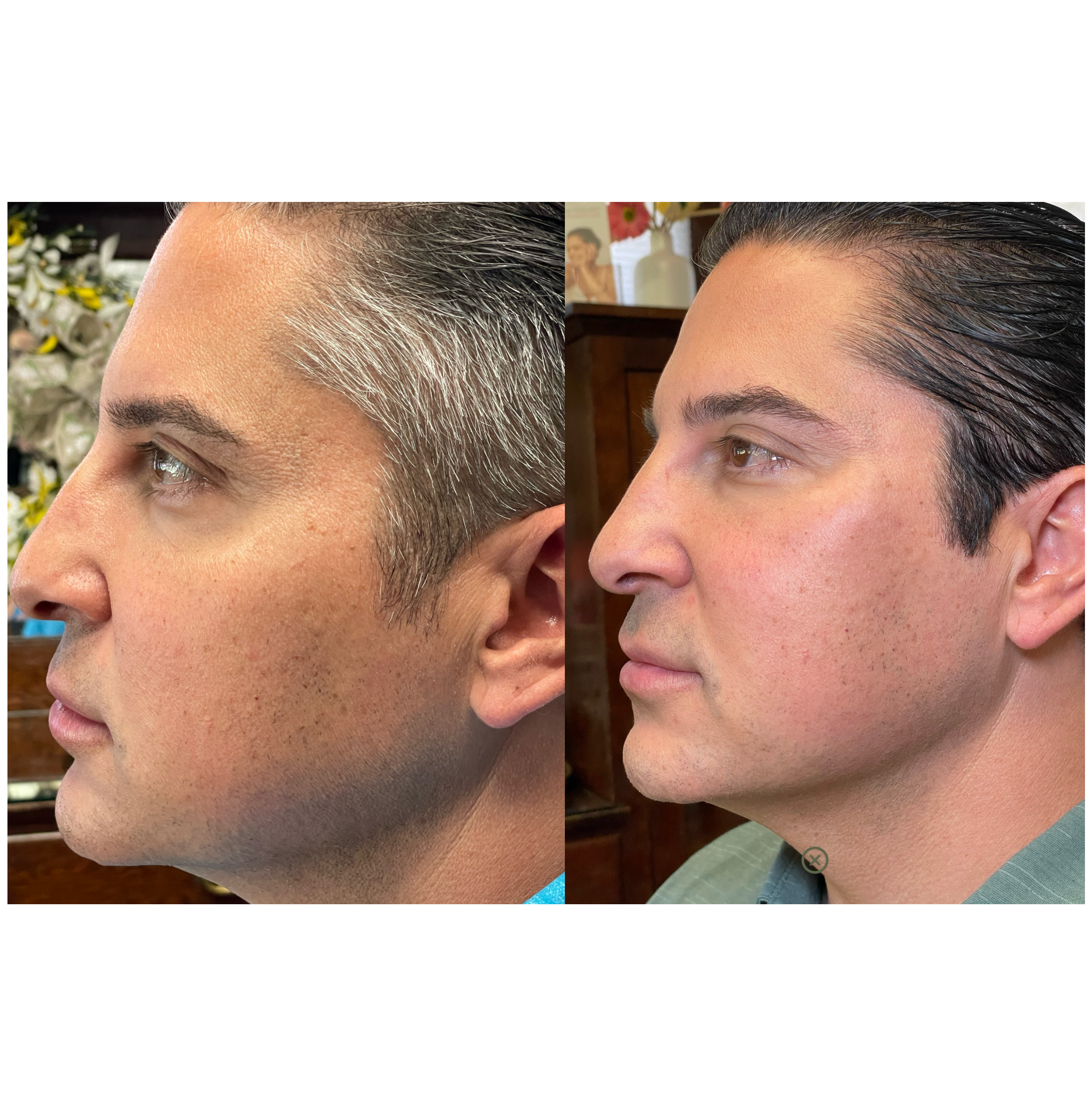 Close-up side view of a person's face before and after hair growth treatments, showing significant facial hair and hairline improvements.