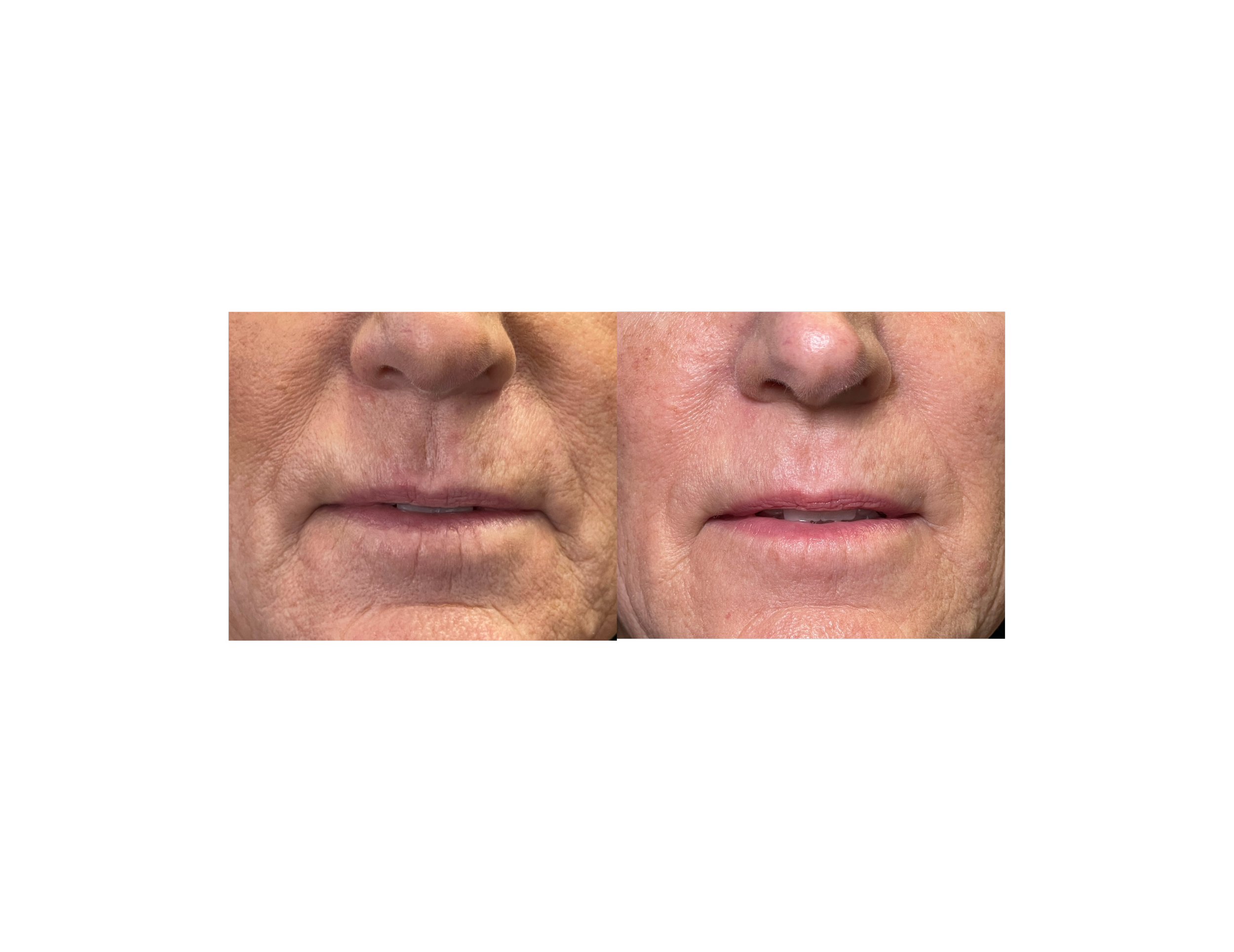 Close-up of a person's face showing before and after cosmetic skin treatment, focusing on nose and cheek areas.