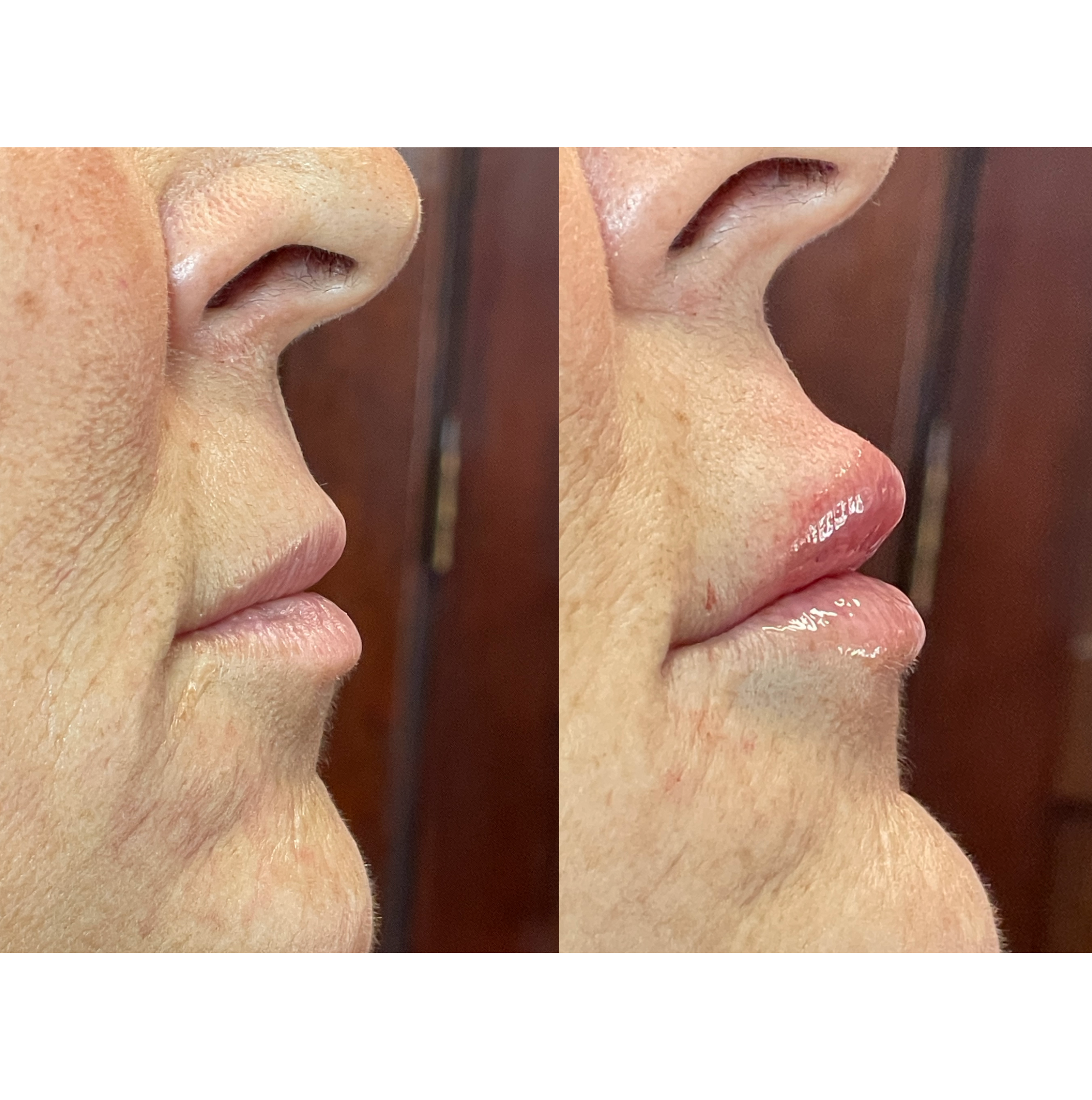 Close-up side profile of a person's nose and lips with visible skin texture.