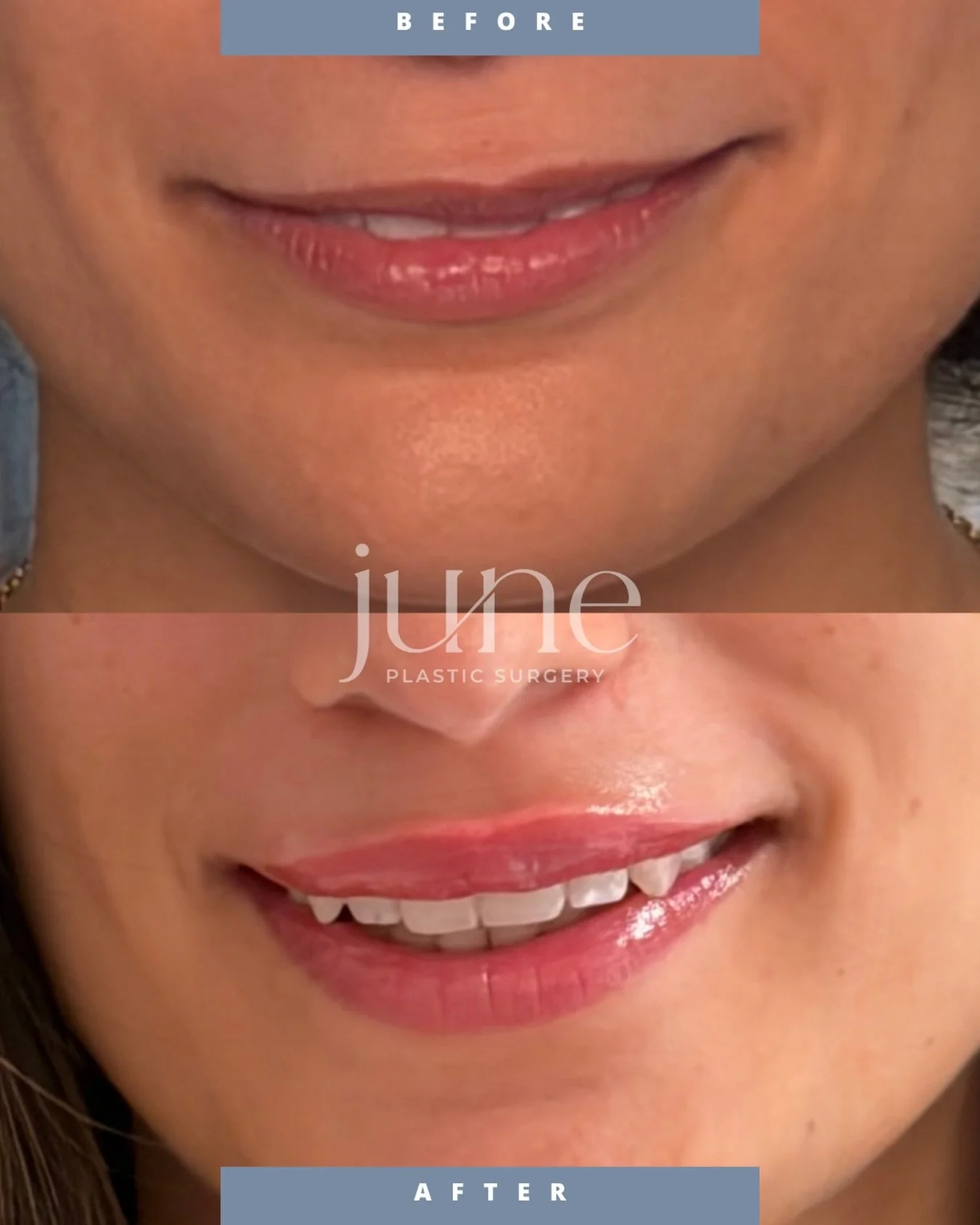 Still you, but better! 🤫 This beautiful patient wanted a slight enhancement in the upper lip, which was achieved with 0.5cc of hyaluronic acid filler. 💋

This is an immediate result and swelling will resolve over 1-2 weeks. Individual results may v