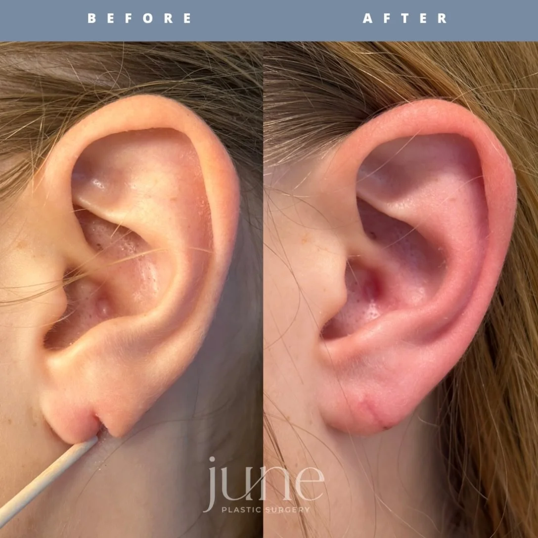 ✨ B&amp;A: SPLIT EARLOBE REPAIR (2wk result) ✨ 

Torn, split, or stretched earlobes from heavy earrings or trauma is a common concern. Did you know that repair can be done wide awake, in the office, in under an hour?!👂🏽🙉

Every ear is different, a