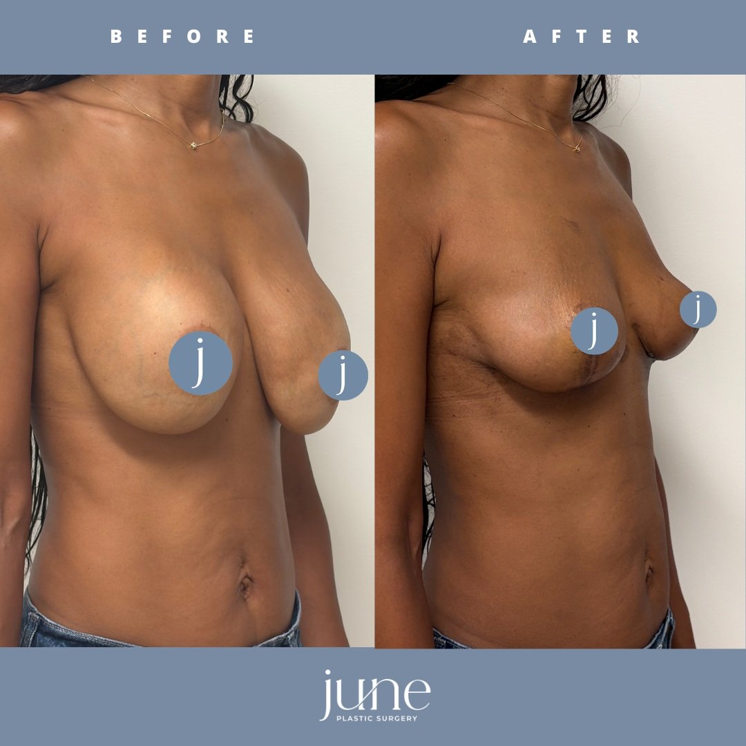 Implant-Out Mastopexy at 2 Months Post Op ✨🍒

This gorgeous patient had painful contracture and discomfort from her large implants. I removed the implants and lifted her native breast tissue to restore the youthful shape she had in the past. These y