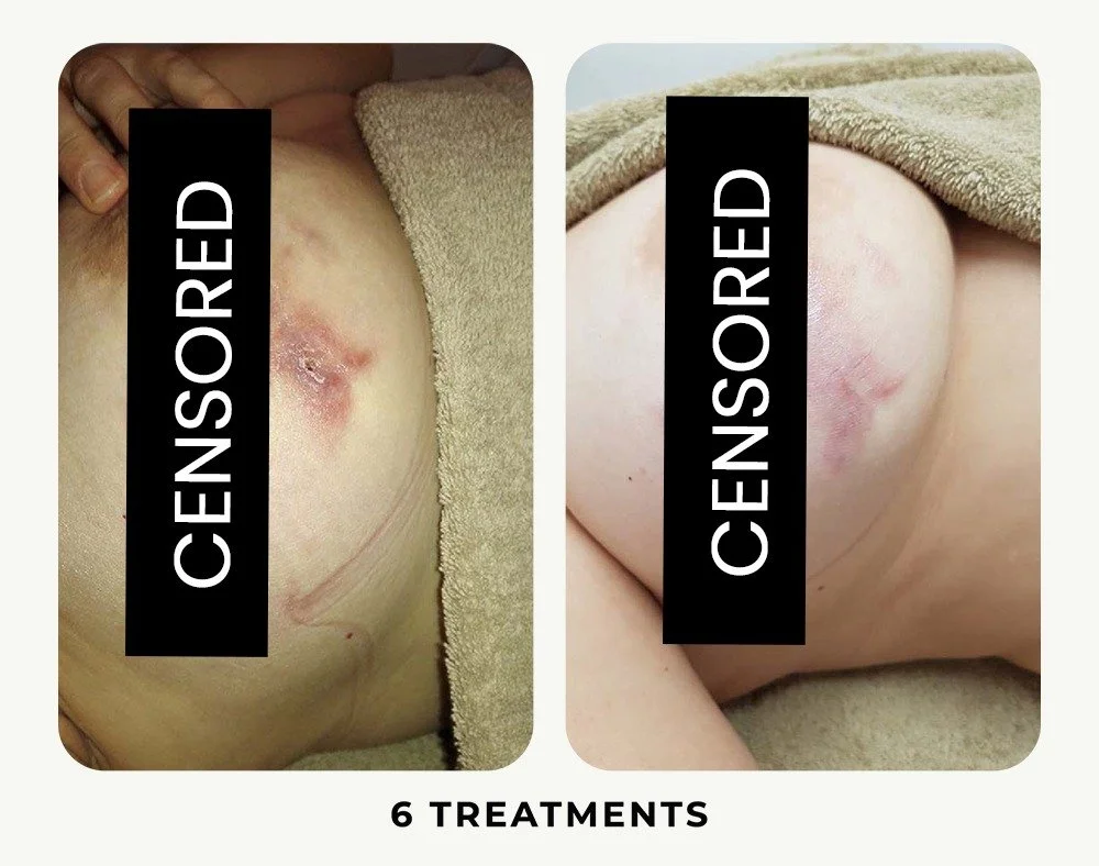 breast.jpeg