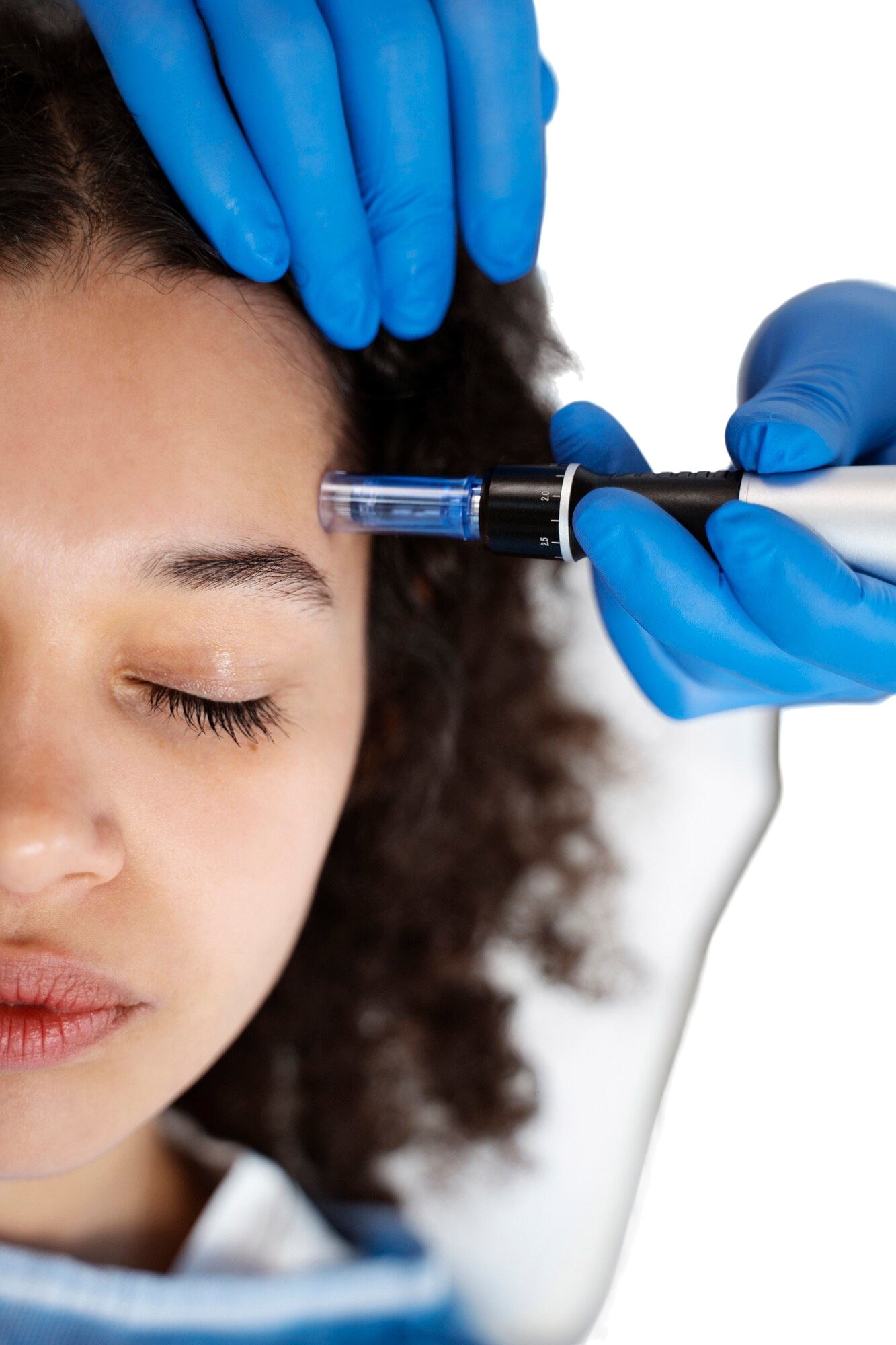 Go laser best Johannesburg microneedling
