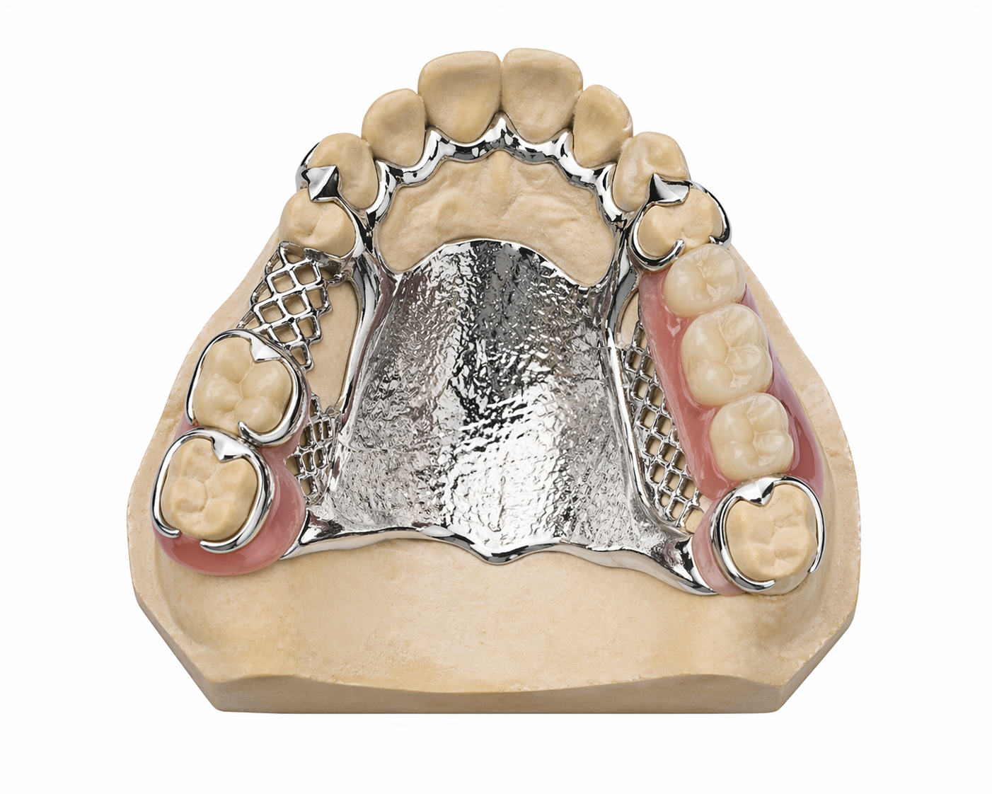 Teilprothese Metallbasis Zahnersatz Oberkiefer Dental Fräszentrum CAD CAM Fertigung Zahnarzt Labor präzise Dentaltechnik